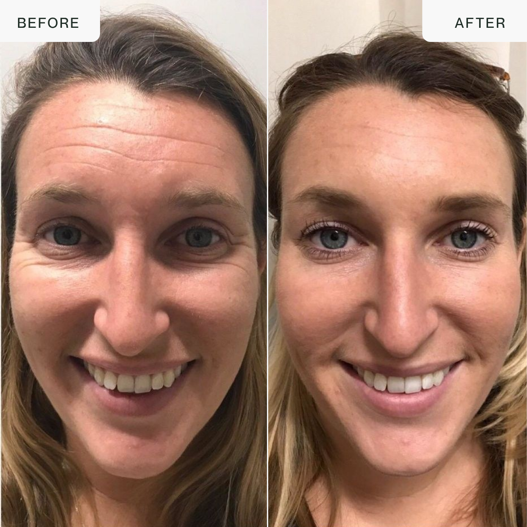 Lámpara LED Pro PDT: terapia fotodinámica para rostro y cuerpo