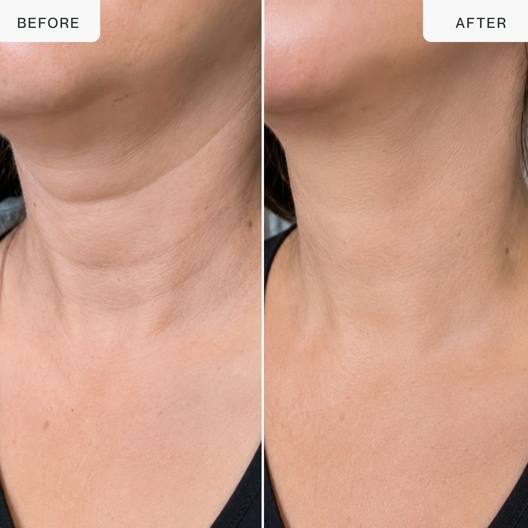 Dispositivo de lifting por RF con oro de 24 quilates — Escultor de rostro y cuello