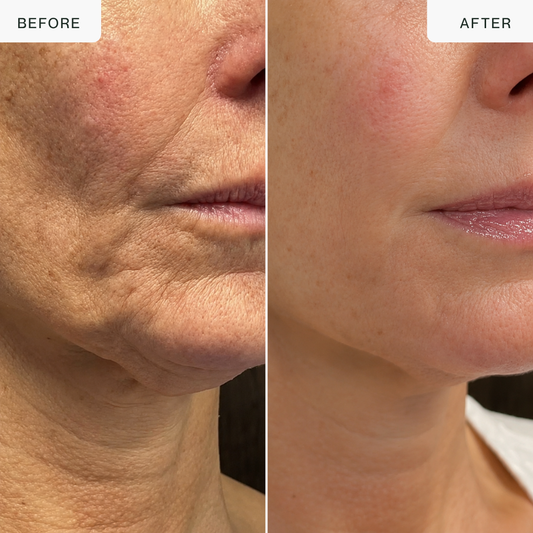 Dispositivo de belleza Multi-RF con oro de 24 quilates: 5 modos para rostro y cuerpo