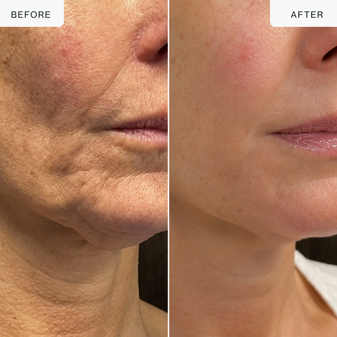 Dispositivo de belleza Multi-RF con oro de 24 quilates: 5 modos para rostro y cuerpo