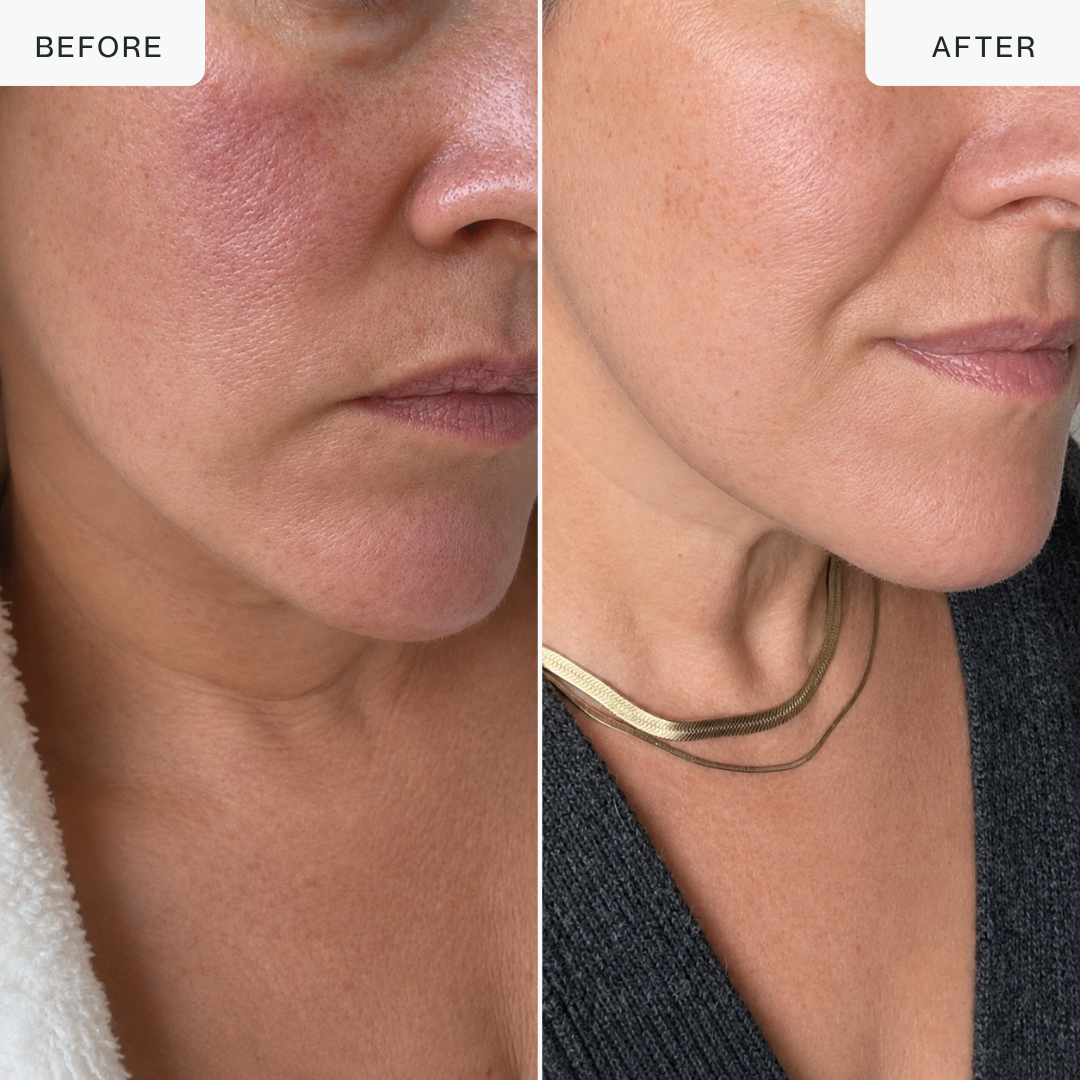 Dispositivo facial y para contorno de ojos 4 en 1
