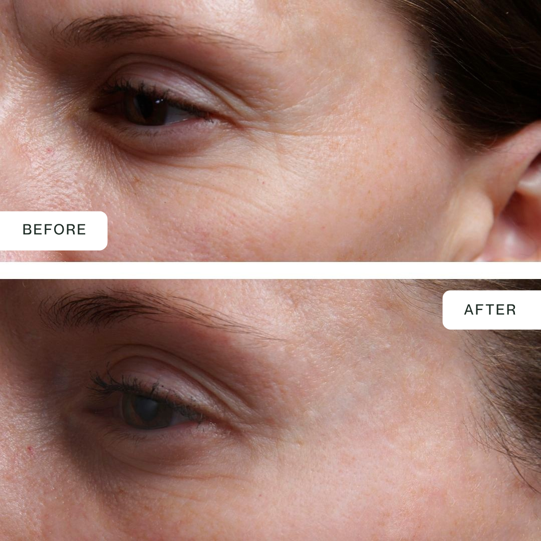 Máscara Eye Glow: terapia LED de triple espectro de 850 nm para el contorno de ojos
