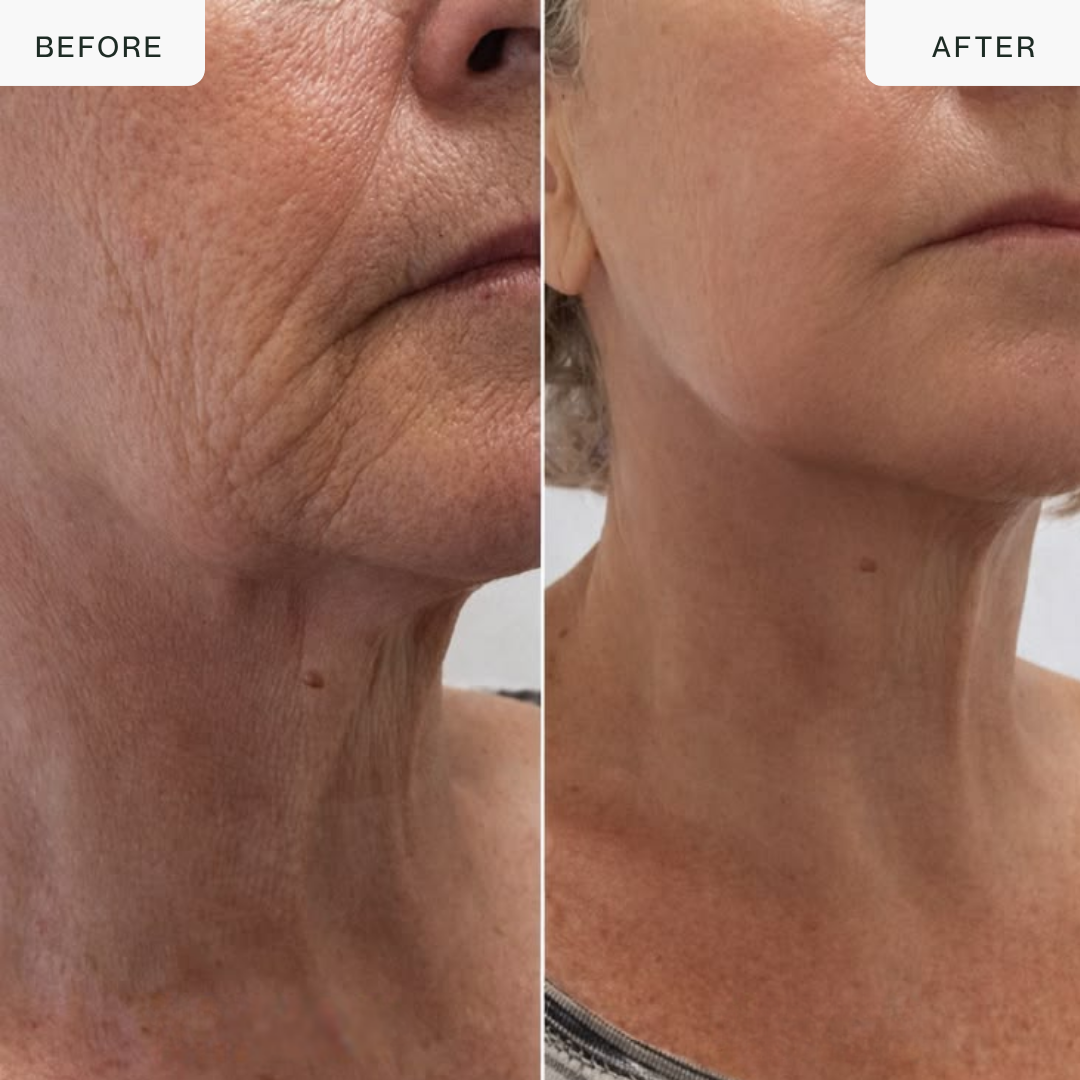 Dispositivo de lifting por RF con oro de 24 quilates — Escultor de rostro y cuello