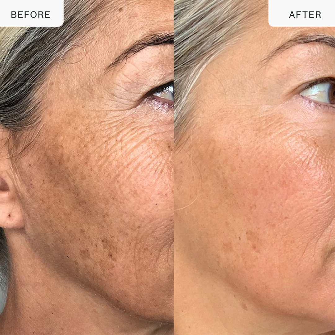 Máscara LED facial Pro con luz roja, azul e infrarroja
